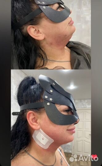 Увеличение губ,мезотерапия лица