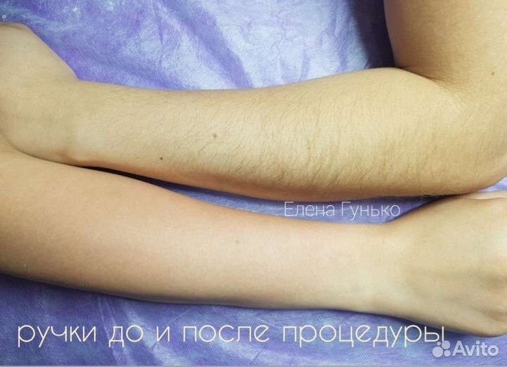 Шугаринг