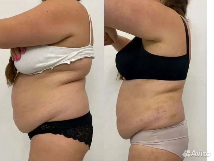 Плоский живот - размер за 1 процедуру в Челябинске