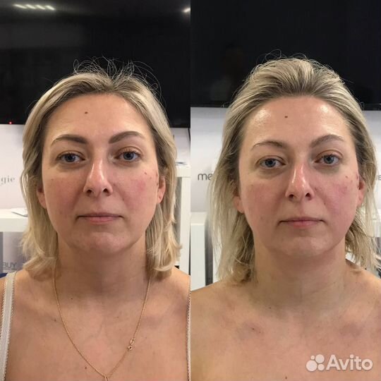 Массаж лица