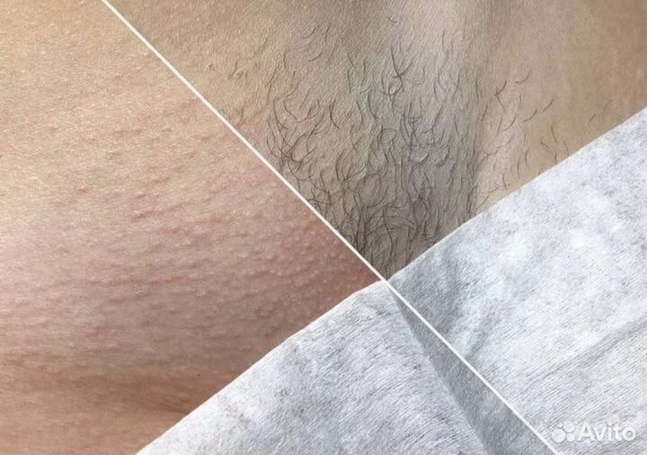 Шугаринг на дому сахарной пастой