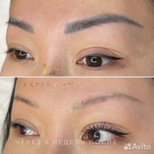 Аппарат Лазер для удаления тату ND Yag Beta