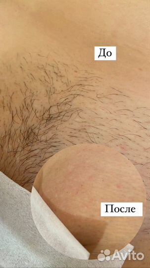 Восковая депиляция, шугаринг