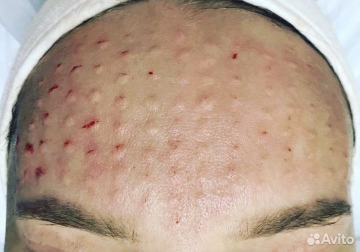 Обучение косметологов.Увеличение губ