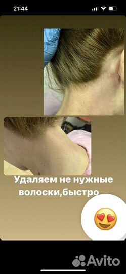 Шугаринг депиляция