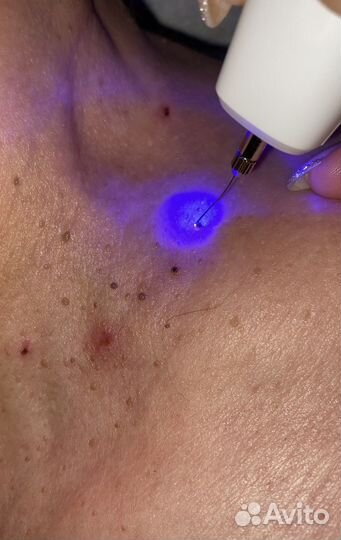 Удаление папиллом