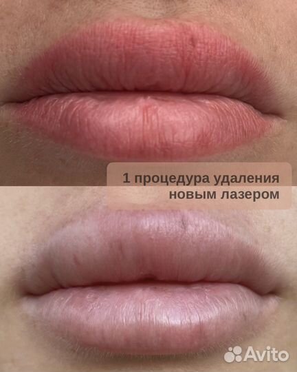 Удаление татуажа Брови/губы/стрелки Лучший Лазер