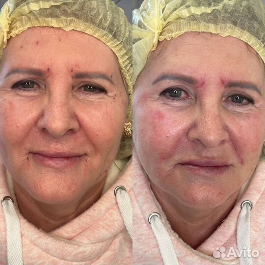 Инъекции ботокса в брови