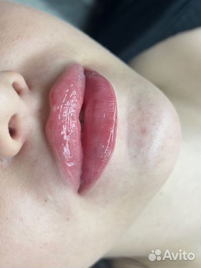 Увеличение губ