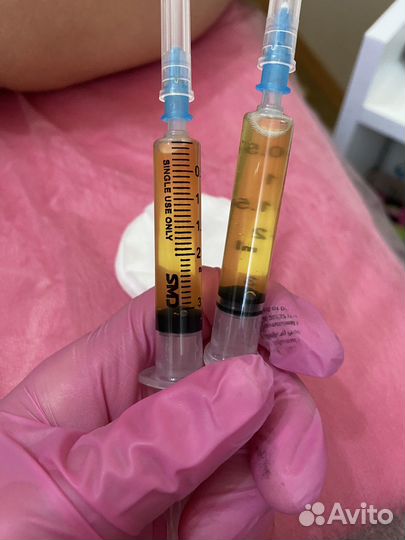 Плазмолифтинг