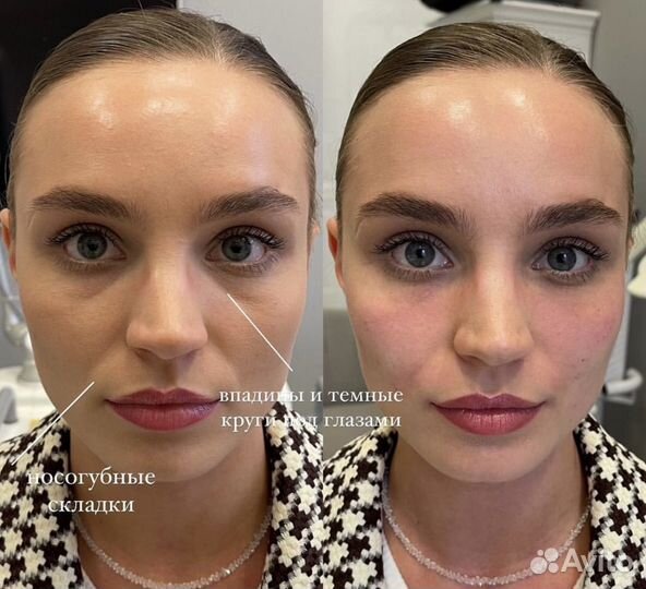 Коррекция носослезной борозды