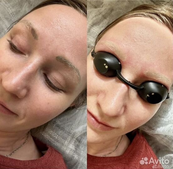 Удаление тату удаление тутажа лазером