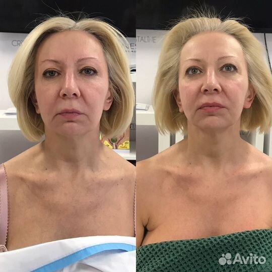 Массаж лица