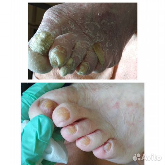 Медицинский Педикюр выезд на дом