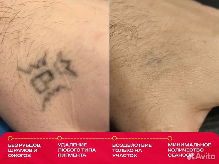 Лазерное удаление татуировки, татуаж, перманент