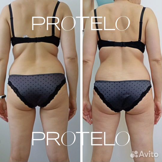 LPG, аппаратный массаж, коррекция фигуры