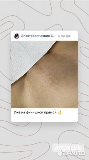 Удаление волос навсегда