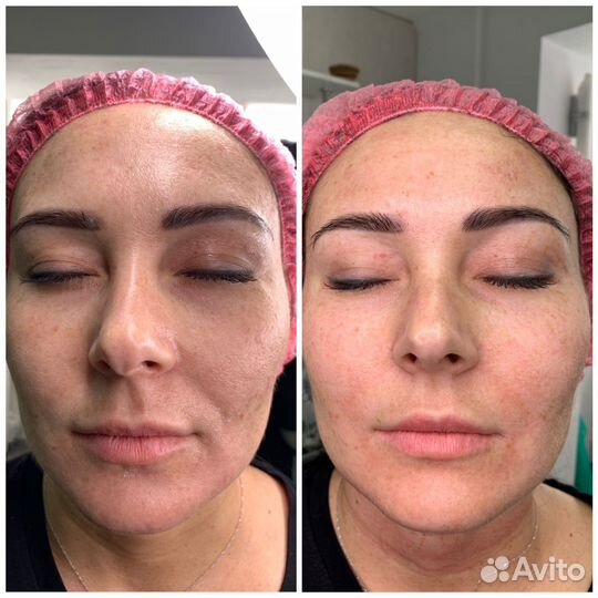 Аппаратное омоложение