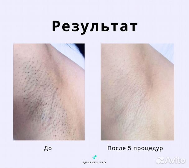 Диодный лазер Lumines’ Макс Ван 1200