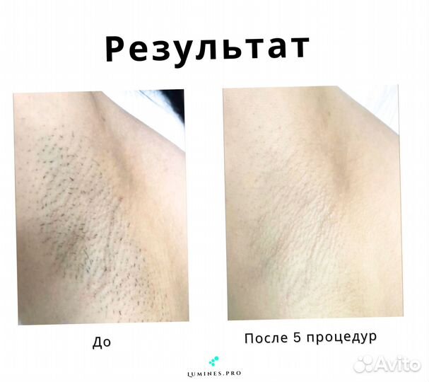 Диодный лазер для эпиляции Lumines Max’One 1200W