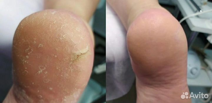 Подологический педикюр гпз/центр