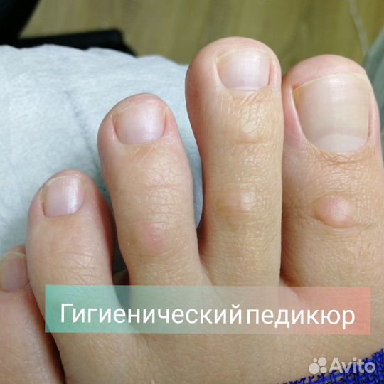 Лечебный педикюр