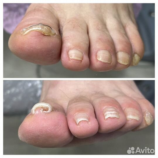 Медицинский педикюр подолог москва