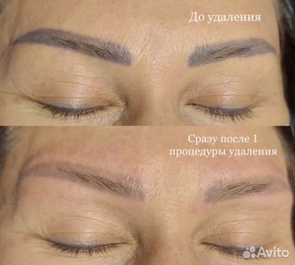 Удаление татуажа