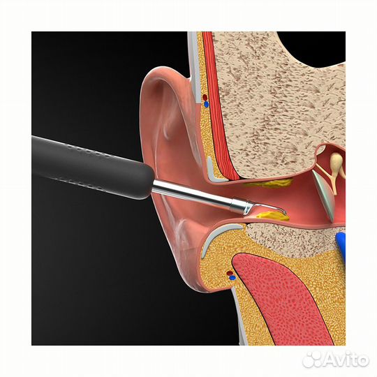 Умная ушная палочка Xiaomi Bebird Smart Visual