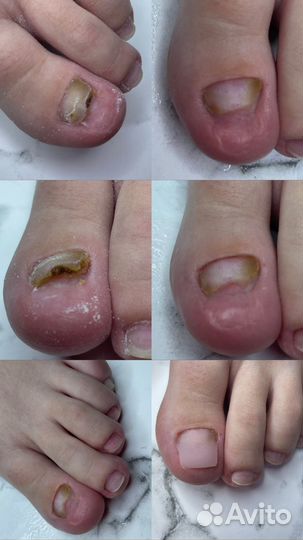 Педикюр подолог