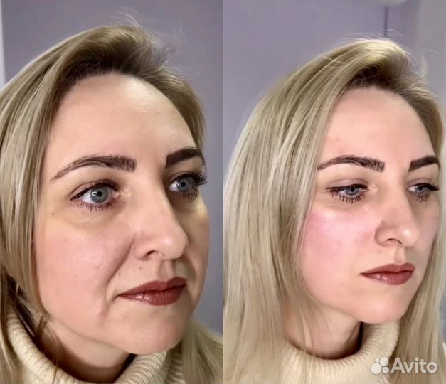 Подтяжка лица мезонитями