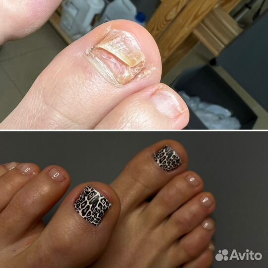 Подология / медицинский педикюр / SMART педикюр