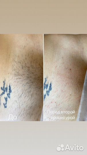 Электроэпиляция