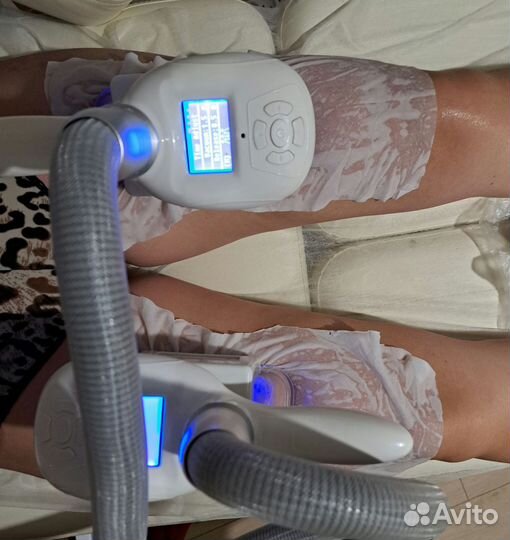 Криолиполиз