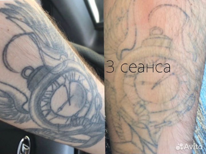 Удаление тату