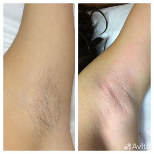 Шугаринг, депиляция