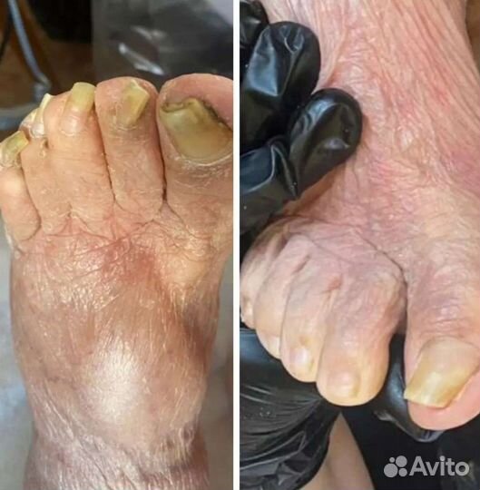 Подолог мозоли натоптыши грибки и др