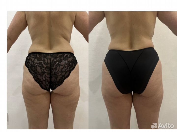 Антицеллюлитный массаж ручной Мадера Пролетарская