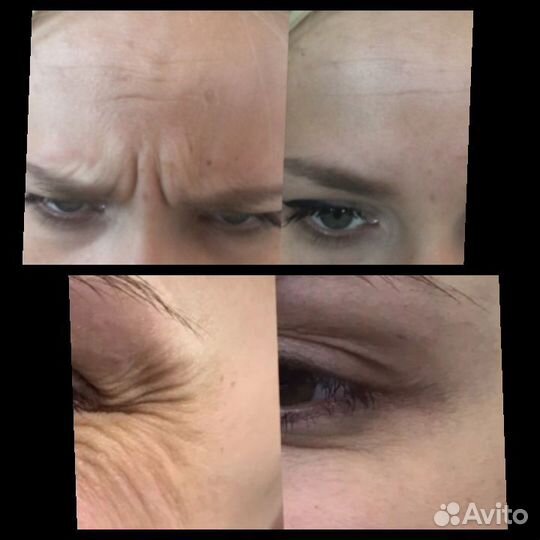 Ботокс лоб,глаза