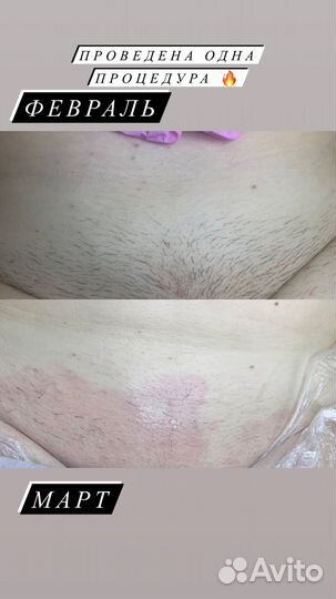 Электроэпиляция