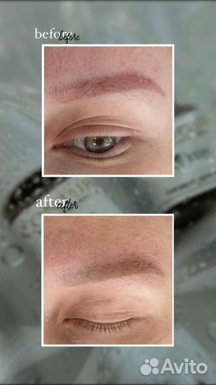 Лазерное удаление татуажа