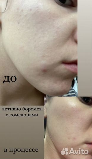 Чистка лица, пилинг