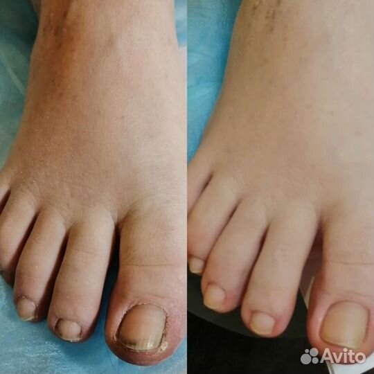 Педикюр на дому
