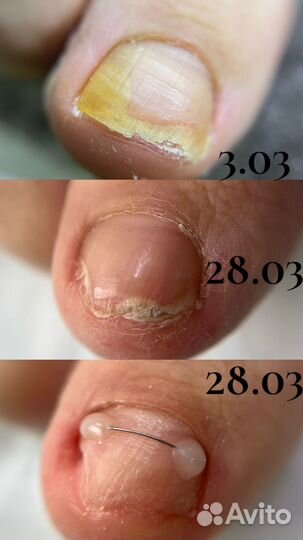 Медицинский педикюр