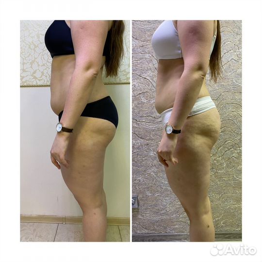 Криолиполиз, LPG, вакуумный массаж, прессотерапия