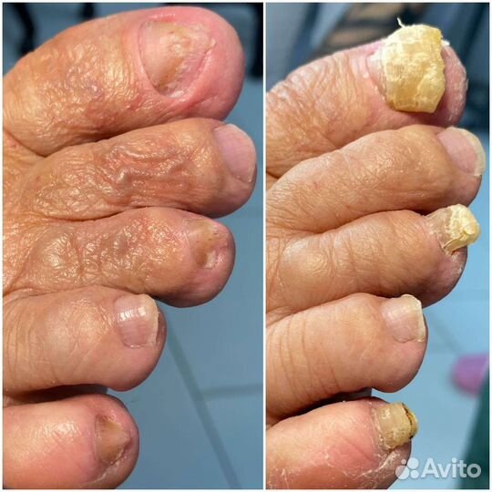 Подолог Выезд на дом Парамедицинский педикюр