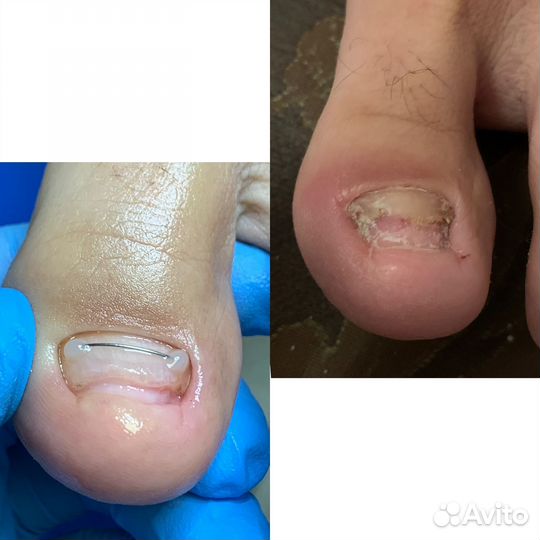 Педикюр,подологические услуги с выездом на дом