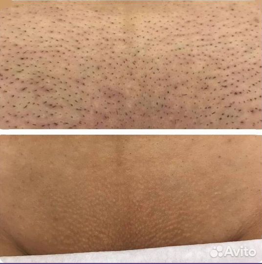 Лазерная эпиляция