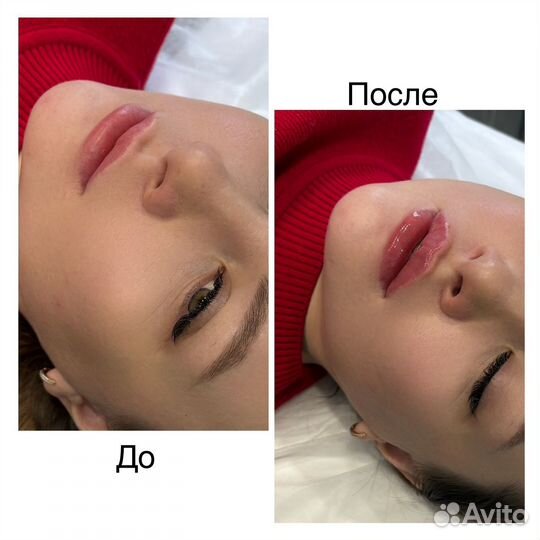 Модель на контурную пластику губ