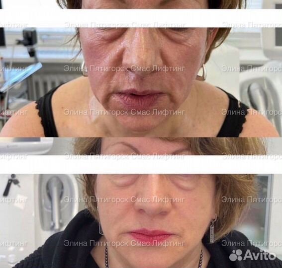 СМАС лифтинг Подтяжка лица уход за лицом